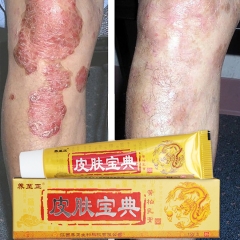 Yongzhi Zheng Herbal Antimicrobial Cream 15g - Soothing Relief for Psoriasis & Itchy Skin. Natural formula combats bacteria, gently treats skin