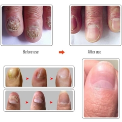 ZUDAIFU 863: Nail recovery Essence, antibacterial treatment, growth promoting solution for healthy and beautiful nails