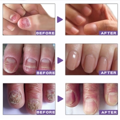 ZUDAIFU 863: Nail recovery Essence, antibacterial treatment, growth promoting solution for healthy and beautiful nails